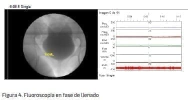 Fluoroscopia en fase de llenado Fluoroscopia en fase de llenado