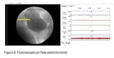 Fluoroscopia en fase postmiccional Fluoroscopia en fase postmiccional