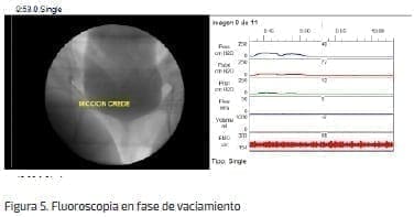 Fluoroscopia en fase de vaciamiento Fluoroscopia en fase de vaciamiento
