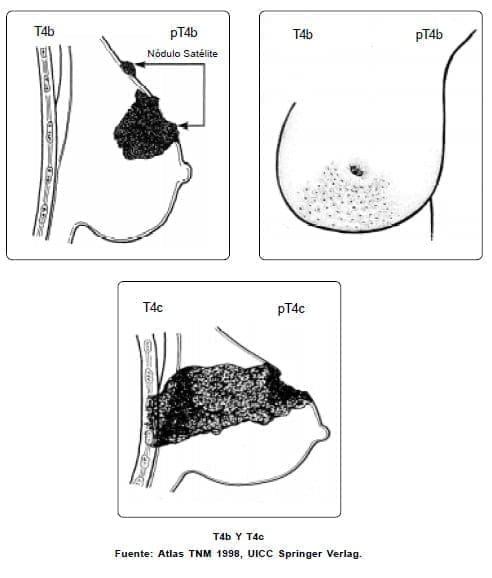 Carcinoma inflamatorio en el Seno Carcinoma inflamatorio en el Seno