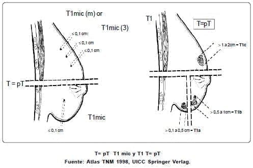 Manejo del cáncer mamario Manejo del cáncer mamario