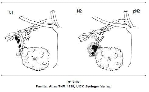 Cáncer mamario Ganglios linfáticos Cáncer mamario Ganglios linfáticos