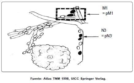 Cáncer de Seno Metástasis Cáncer de Seno Metástasis