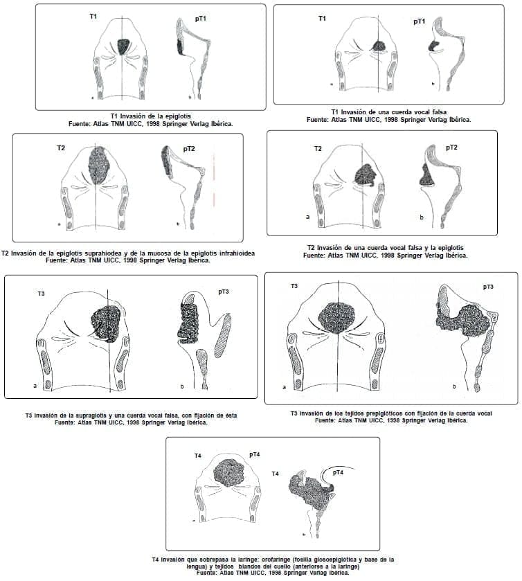 Carcinomas Supraglóticos Carcinomas Supraglóticos