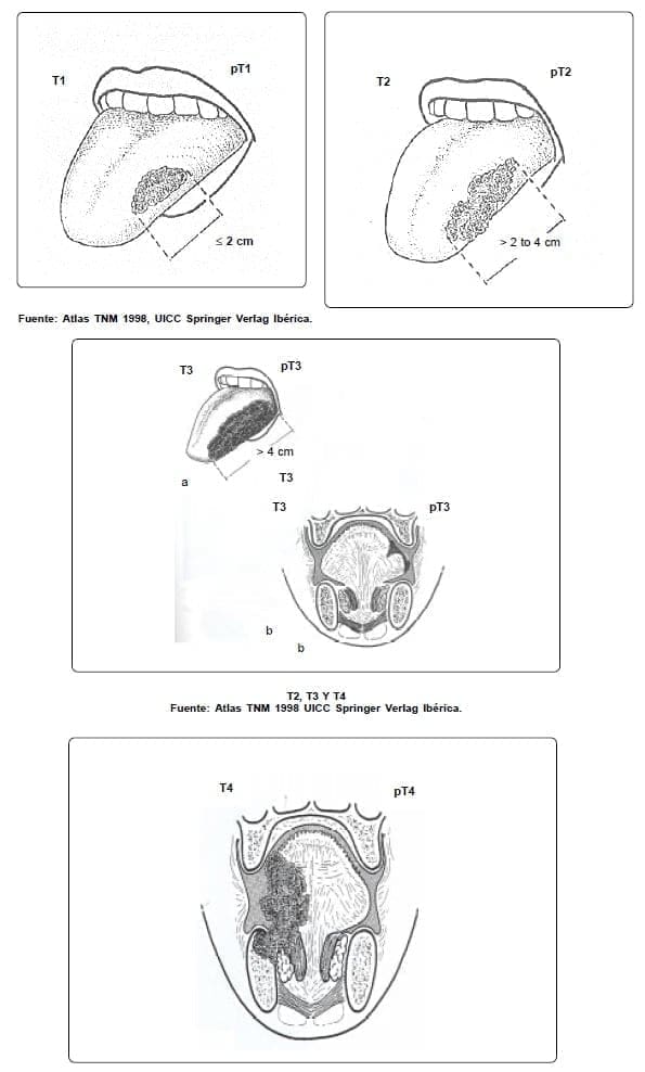 Carcinoma de Lengua - Tumor Primario (T)
