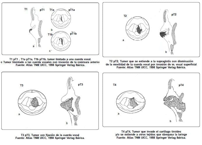 Tumor a las cuerdas vocales Tumor a las cuerdas vocales