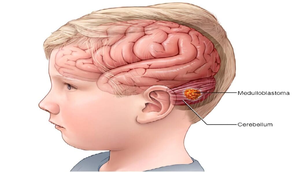 Meduloblastoma