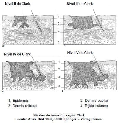 Melanoma - Niveles de invasión según Clark Melanoma - Niveles de invasión según Clark