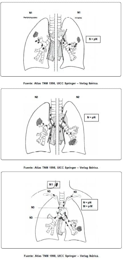 Metástasis en ganglios peribronquiales Metástasis en ganglios peribronquiales