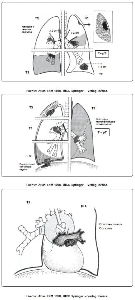 Lóbulo pulmonar del tumor primario Lóbulo pulmonar del tumor primario
