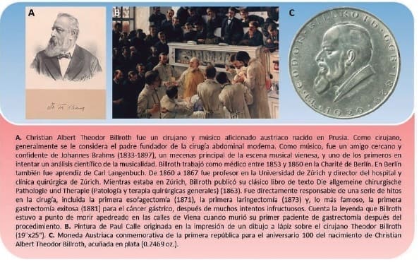 Cirujano alemán Theodore Billroth, llevó a cabo la primera extirpación pilórica