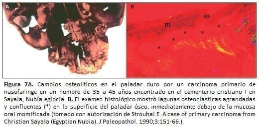 Carcinoma primario de nasofaringe en un hombre de 35 a 45 años
