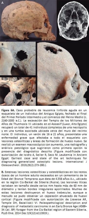 Leucemia linfoide aguda en un esqueleto de un individuo del Antiguo 