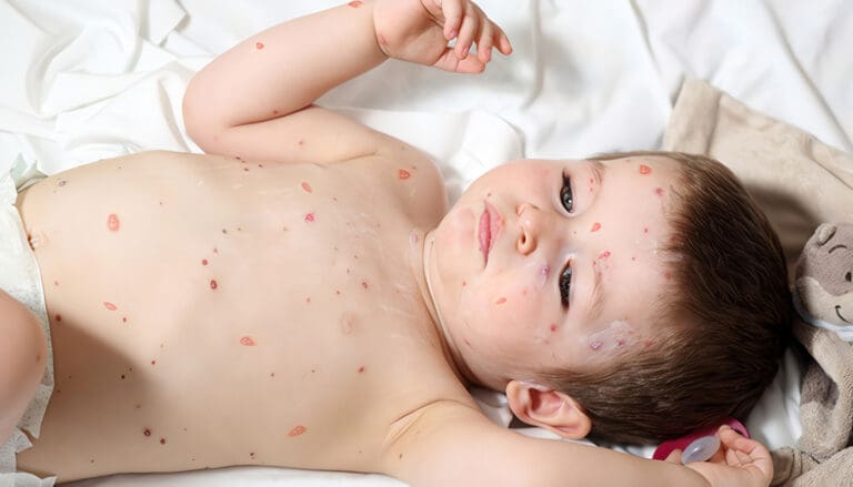 Remedios caseros para la varicela