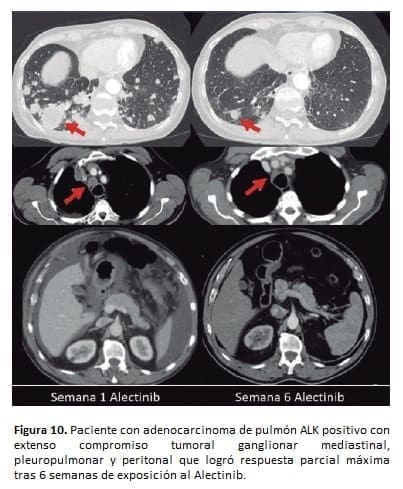 Paciente con adenocarcinoma de pulmón ALK Paciente con adenocarcinoma de pulmón ALK