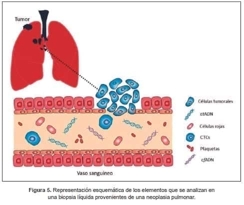 Biopsia líquida provenientes de una neoplasia pulmonar Biopsia líquida provenientes de una neoplasia pulmonar