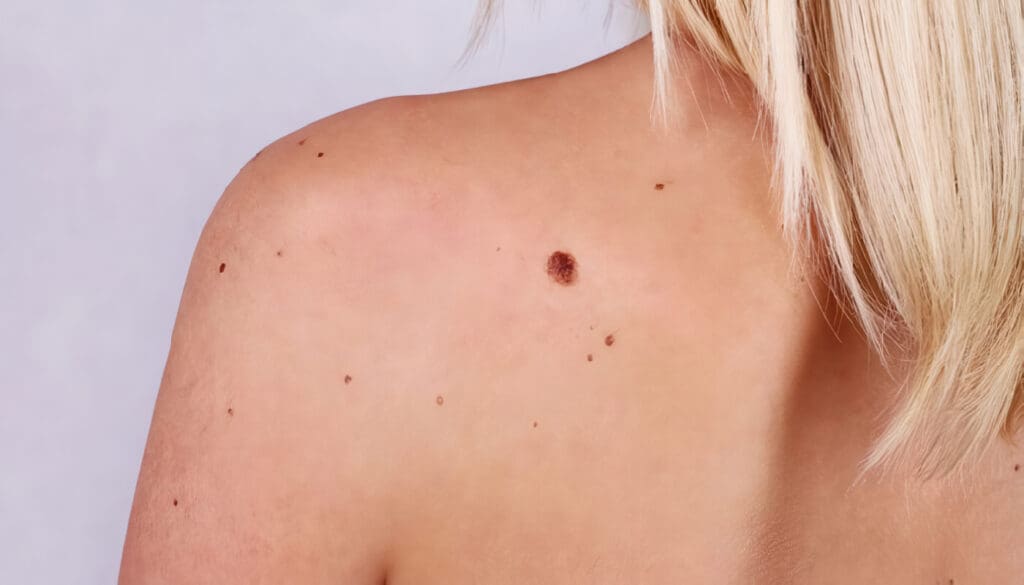 Guía Clínica para el diagnóstico, tratamiento y seguimiento del cáncer de piel no melanoma