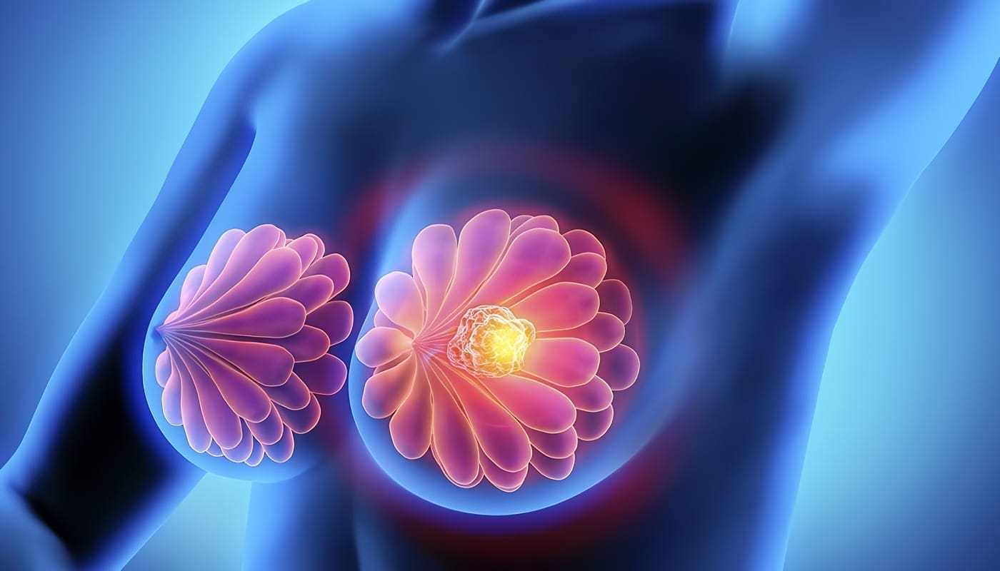 Cáncer de Mama detectarlo a tiempo