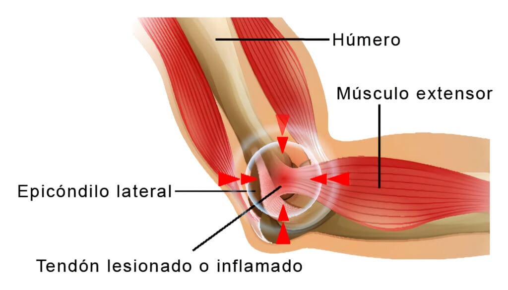 Cómo tratar la epicondilitis