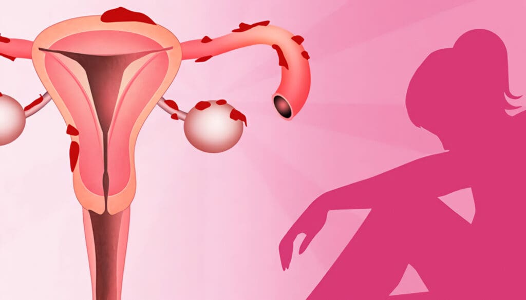Endometriosis síntomas y tratamientos