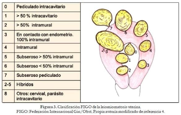 Clasificación FIGO de la leiomiomatosis uterina