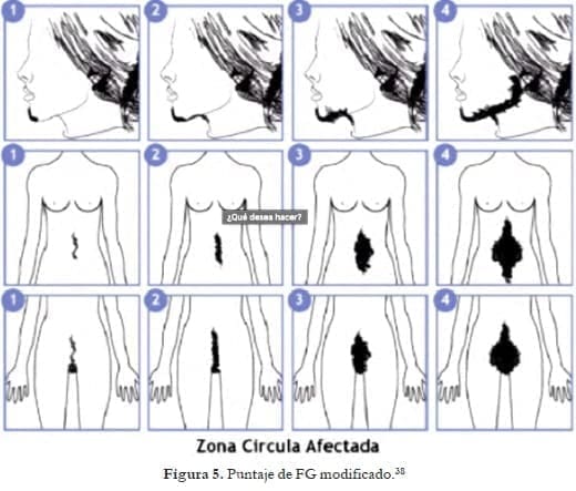 Detectar el hirsutismo Detectar el hirsutismo