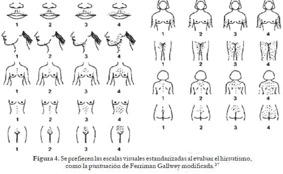 Escalas visuales estandarizadas al evaluar el hirsutismo Escalas visuales estandarizadas al evaluar el hirsutismo