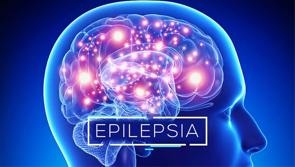 Qué es la Epilepsia