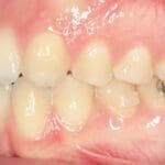 Arco personalizado tecnología 3D