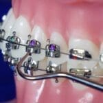 Brackets autoligables