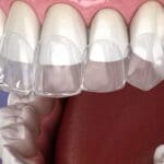 Ortodoncia alineadores invisibles