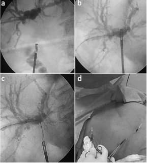 Secuencia del rendezvous percutáneo-laparoscópico Secuencia del rendezvous percutáneo-laparoscópico