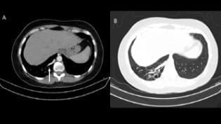 Secuestro pulmonar en lóbulo inferior derecho