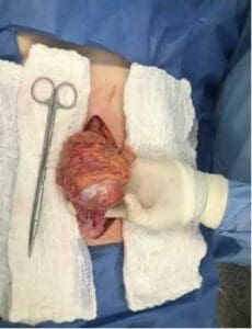 Teratoma dependiente del omento mayor Teratoma dependiente del omento mayor