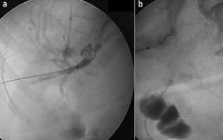 Instrumentación Biliar Percutánea -Colangiografía transparieto-hepática Instrumentación Biliar Percutánea -Colangiografía transparieto-hepática