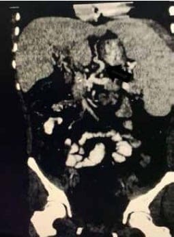 Angiotac de control donde se aprecia el injerto permeable Angiotac de control donde se aprecia el injerto permeable