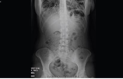 Abdomen con abundante cantidad de material fecal 