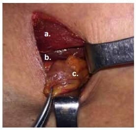 Adenoma de paratiroides  inferior izquierda