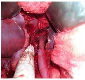 Trombosis Venosa Portal Extrahepática - Anastomosis portal Trombosis Venosa Portal Extrahepática - Anastomosis portal