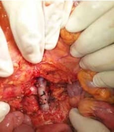 Anastomosis a la vena mesentérica superior Anastomosis a la vena mesentérica superior