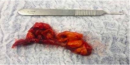 Apéndice cecal en fase gangrenosa Apéndice cecal en fase gangrenosa