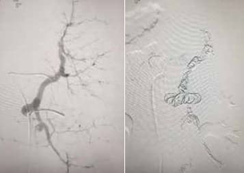 Arteriografía de la arteria esplénica Arteriografía de la arteria esplénica