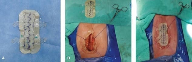 Placa de Biobridge y pericardio bovino - Agenesia Esternal Total