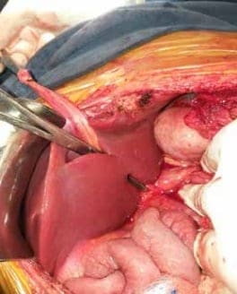 Trombosis Venosa Portal Extrahepática - Cisura de Rex Trombosis Venosa Portal Extrahepática - Cisura de Rex