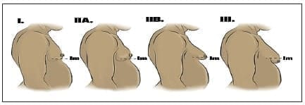 Clasificación de la ginecomastia según Simon BE