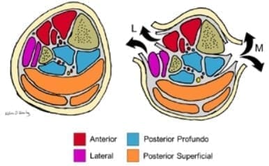 Compartimientos de la pierna y sus abordajes en fasciotomía