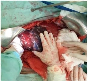 Desempaquetamiento del lóbulo hepático derecho Desempaquetamiento del lóbulo hepático derecho