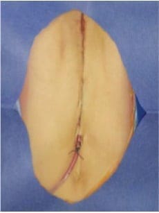 Resultado final con dren de Jackson Pratt