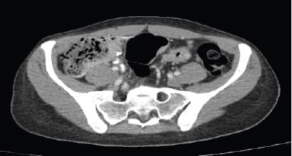 Engrosamiento concéntrico de las paredes del colon
sigmoide