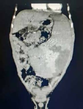 Esplenomegalia severa Esplenomegalia severa